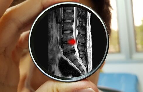 Důsledkem ignorování bolesti dolní části zad může být herniace disku. 