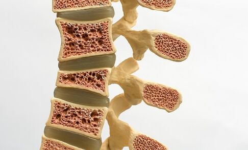 Osteoporóza je jednou z příčin bolesti dolní části zad