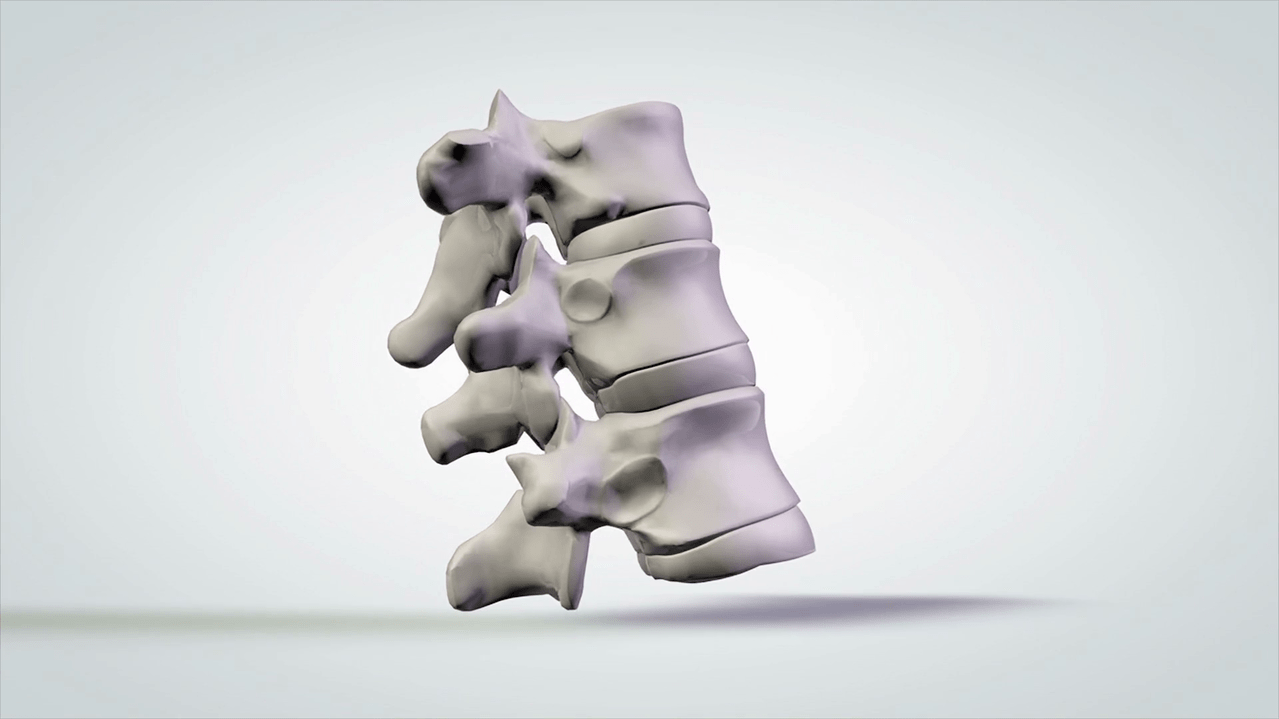 poškození páteře v důsledku cervikální osteochondrózy