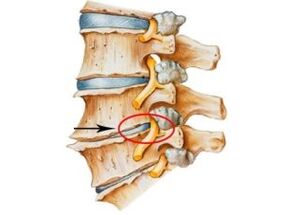 příznaky a symptomy osteochondrózy